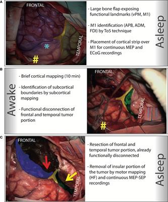 Challenging Giant Insular Gliomas With Brain Mapping: Evaluation of Neurosurgical, Neurological, Neuropsychological, and Quality of Life Results in a Large Mono-Institutional Series